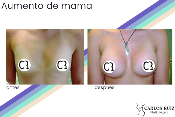 Dr. Carlos Ruiz Zepeda - Cirujano Plástico | Aumento de mama, caso 1, antes y después