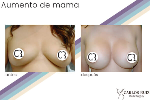 Dr. Carlos Ruiz Zepeda - Cirujano Plástico | Aumento de mama, caso 2, antes y después