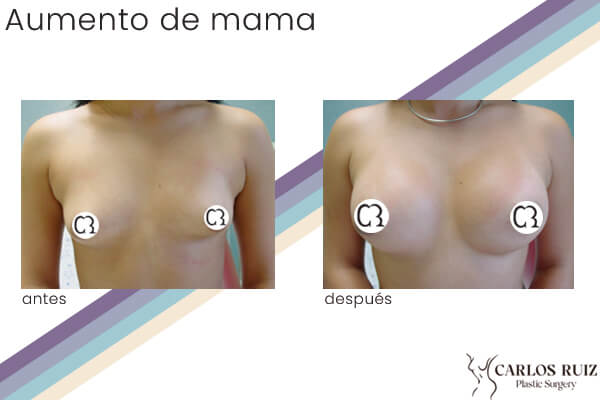 Dr. Carlos Ruiz Zepeda - Cirujano Plástico | Aumento de mama, caso 5, antes y después