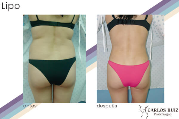 Dr. Carlos Ruiz Zepeda - Cirujano Plástico | Liposucción, caso 2, antes y después (dorso)