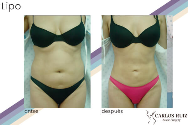 Dr. Carlos Ruiz Zepeda - Cirujano Plástico | Liposucción, caso 1, antes y después (frente)