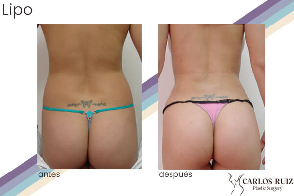 Dr. Carlos Ruiz Zepeda - Cirujano Plástico | Liposucción, caso 2, antes y después (dorso)